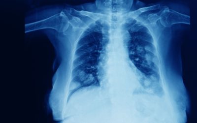 130 day wait for cancer treatments in Scotland (target: 62 days)